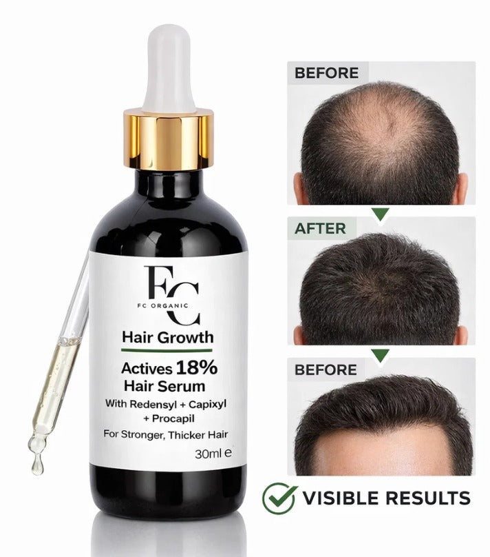 Herbal Hair Growth Serum 30ml | Rosemary & Onion Water-Based Formula. 3763926