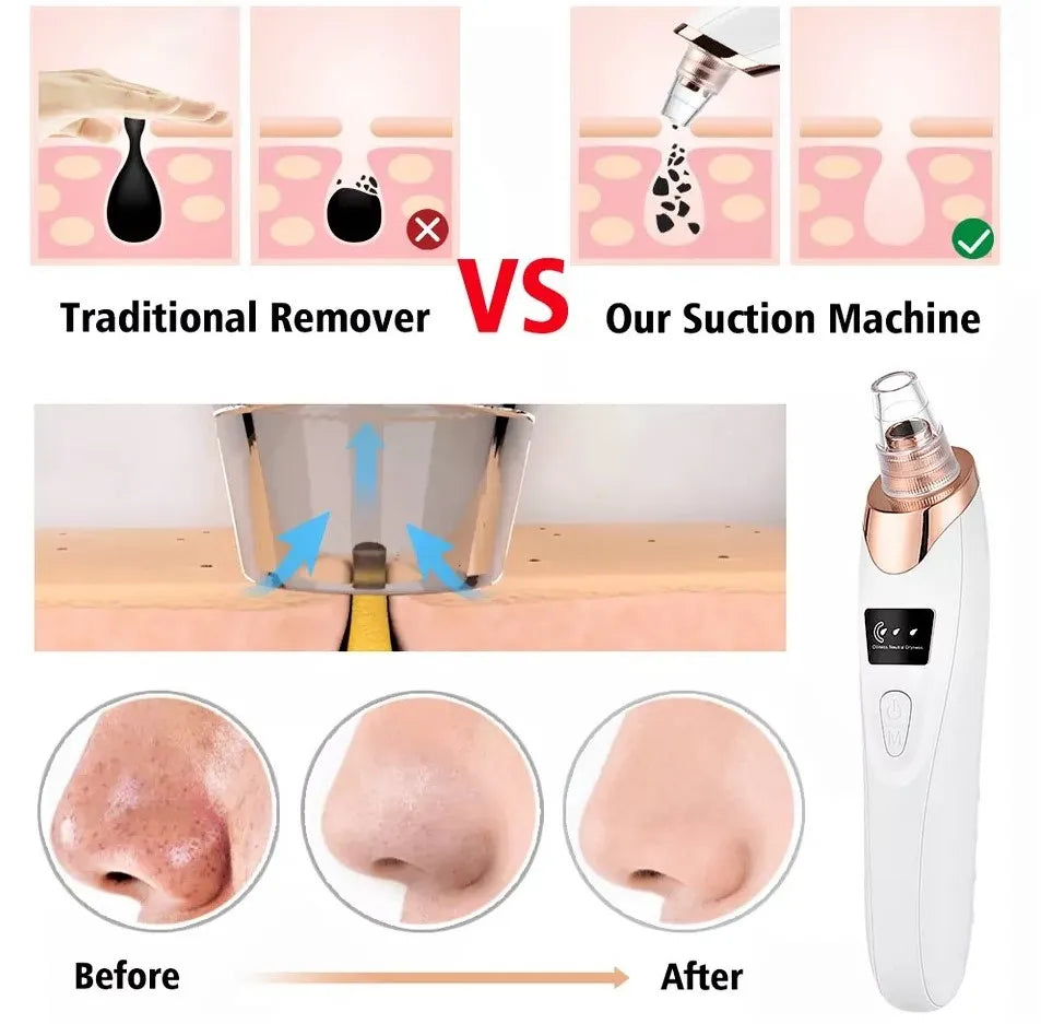 5in1 Blackhead Remover Machine Rechargeable | Face Vacuum Derma Suction With 5 Heads | Blackhead Removing Machine3764491